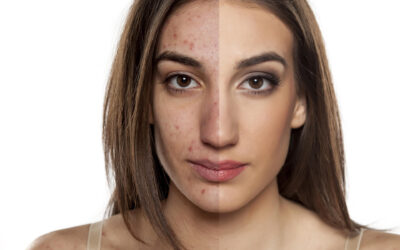 Compounding Solutions & Treatments for Scarring