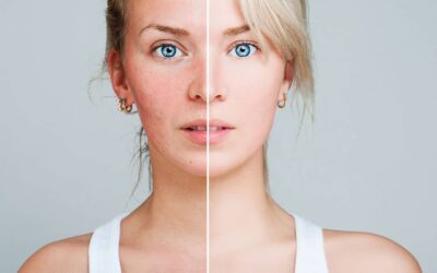 Managing Acne with compounding