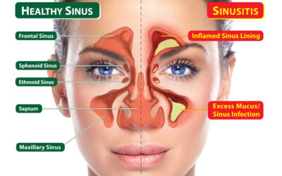 Sinusitis: Causes, Symptoms, Treatments